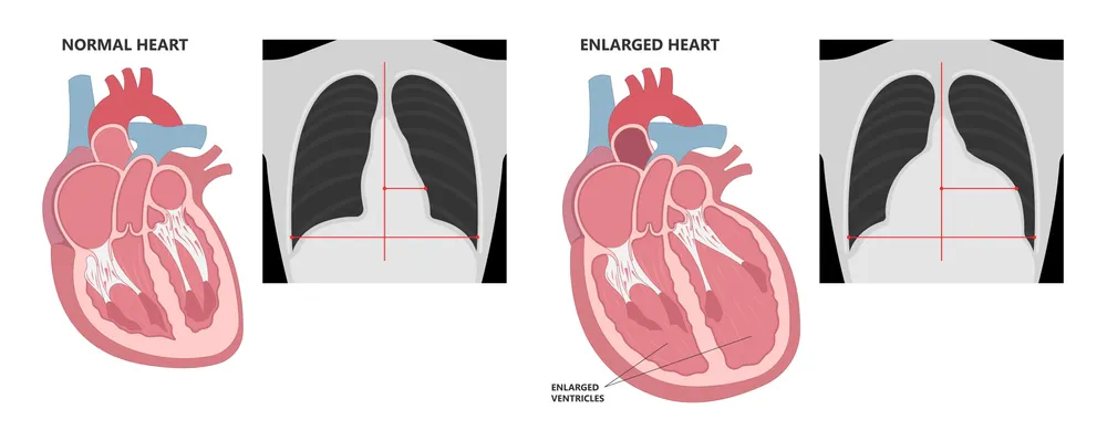 Cardiomegalie (inima mărită): Simptome, cauze, diagnostic și tratament