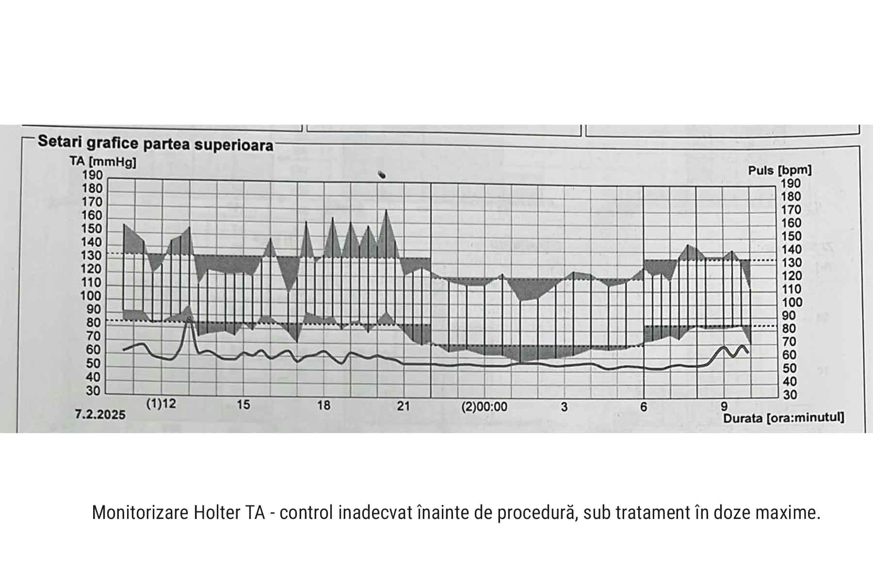 Monitorizare Holter TA-control inadecvat al tensiunii arteriale inainte de procedura  sub tratament in doza maximala a 5 antiheprtensive:
