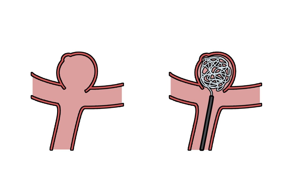 Embolizare anevrism cerebral cu coil.