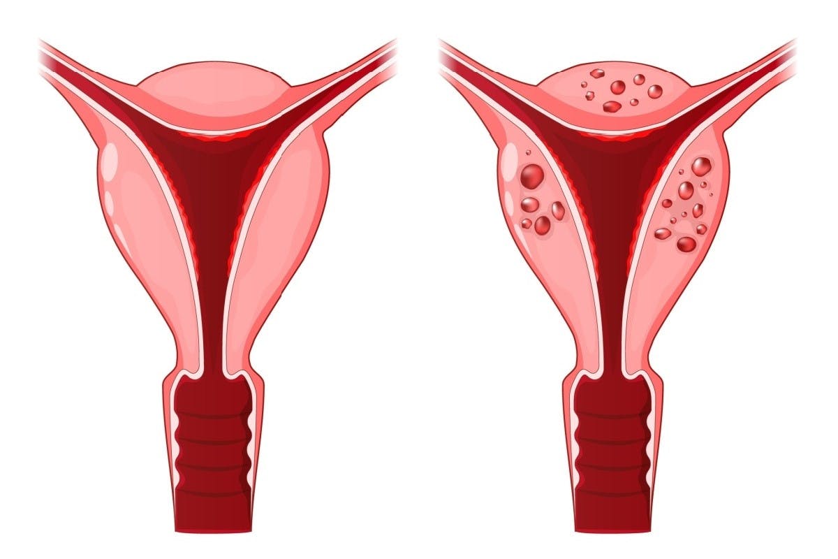 Comparatie intre un uter normal si un uter cu adenomioza.