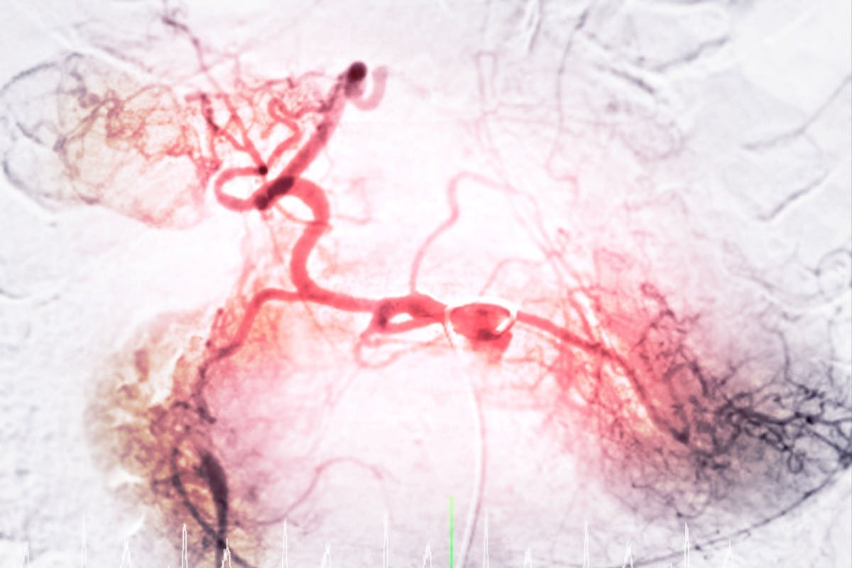 Angiogramă a unei artere în timpul unei proceduri de embolizare