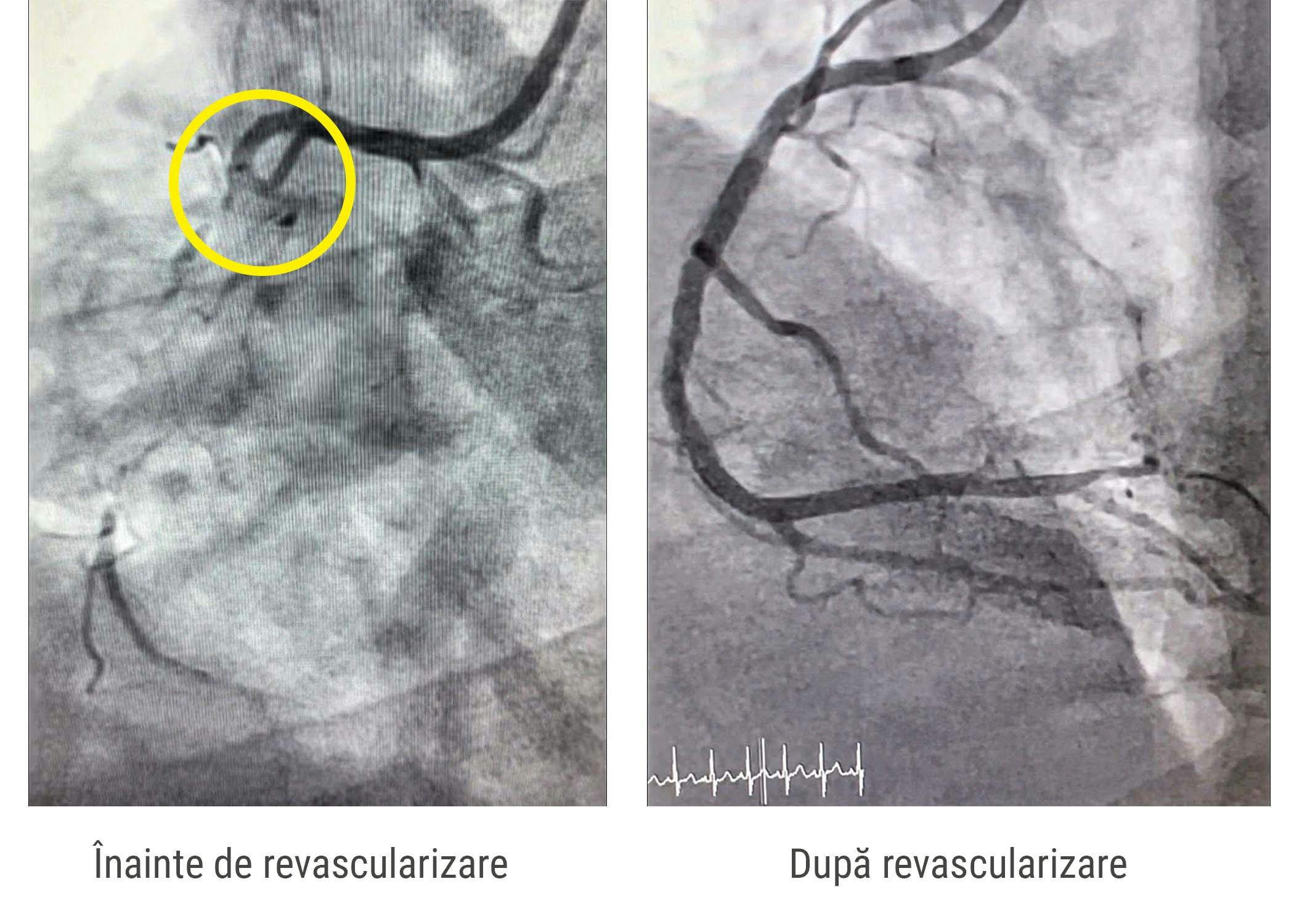 Imagine inainte si dupa revascularizarea miocardica