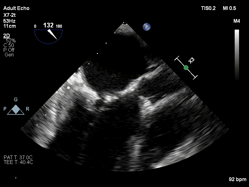 Imagine ecografie transesofagiana valva mitrala cu calcificari importante la nivelul cuspelor si al inelului, cu mobilitate limitata a cuspelor