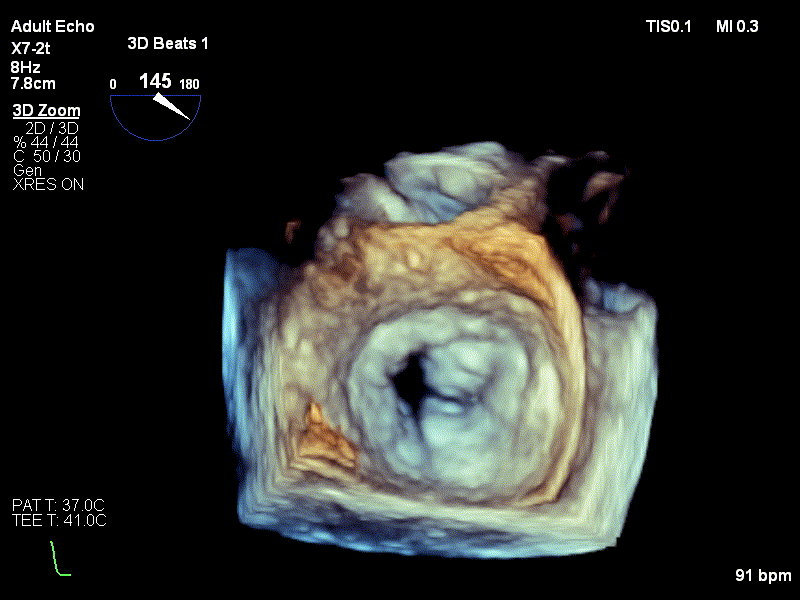 Ecografie 3D valva mitrala cu calcificari severe la nivelul cuspelor si al inelului, cu mobilitate mult diminuata