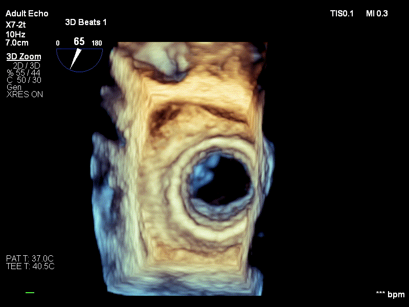 Ecografie 3D post implant proteza biologica Edwards Sapien 3 in pozitie mitrala (TAVI in MAC)