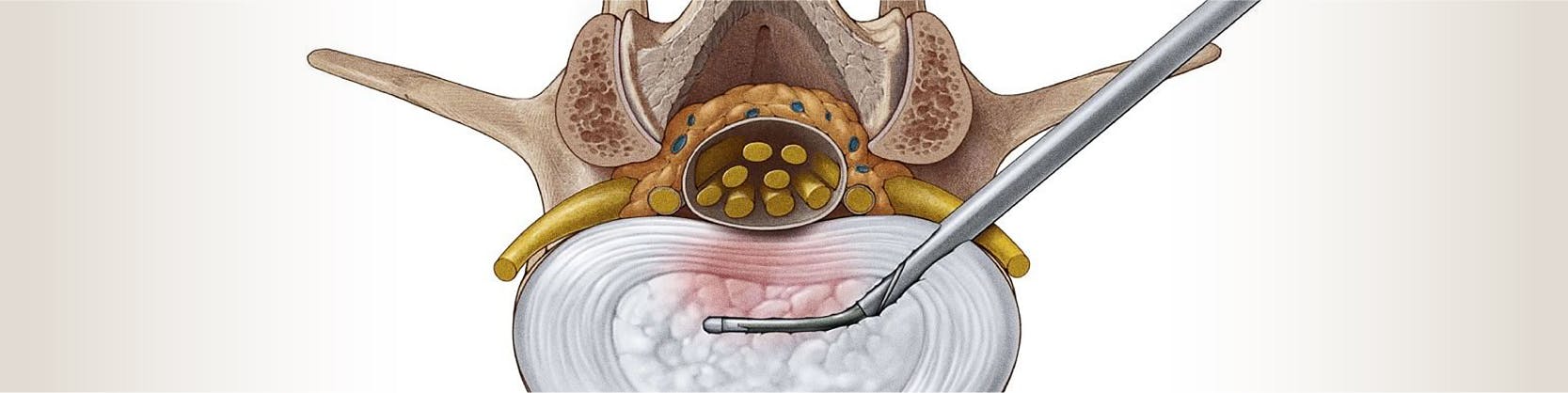 Tratament hernie de disc | MONZA ARES | Neuroradiologie interventionala