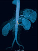 Stenoza de artere renale - Cauze, simptome și tratament