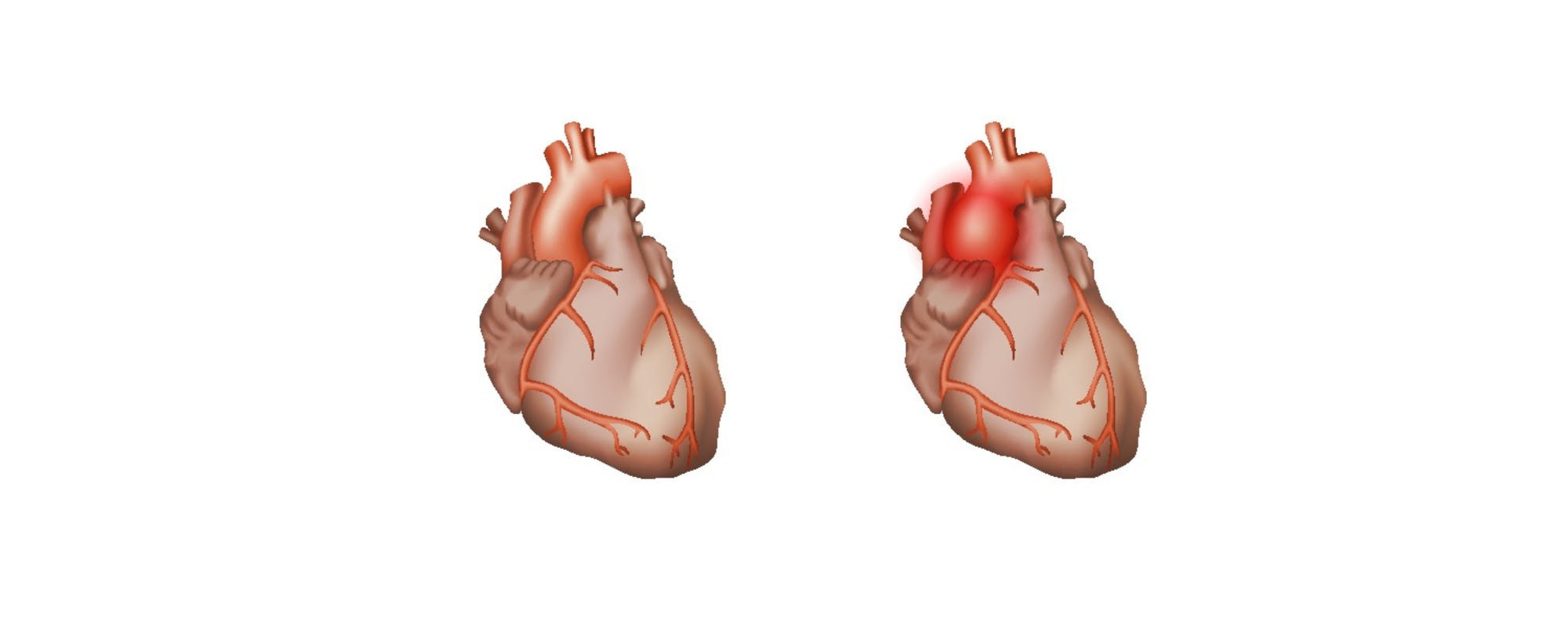 Chirurgia aortei ascendente prin minitoracotomie | MONZA ARES