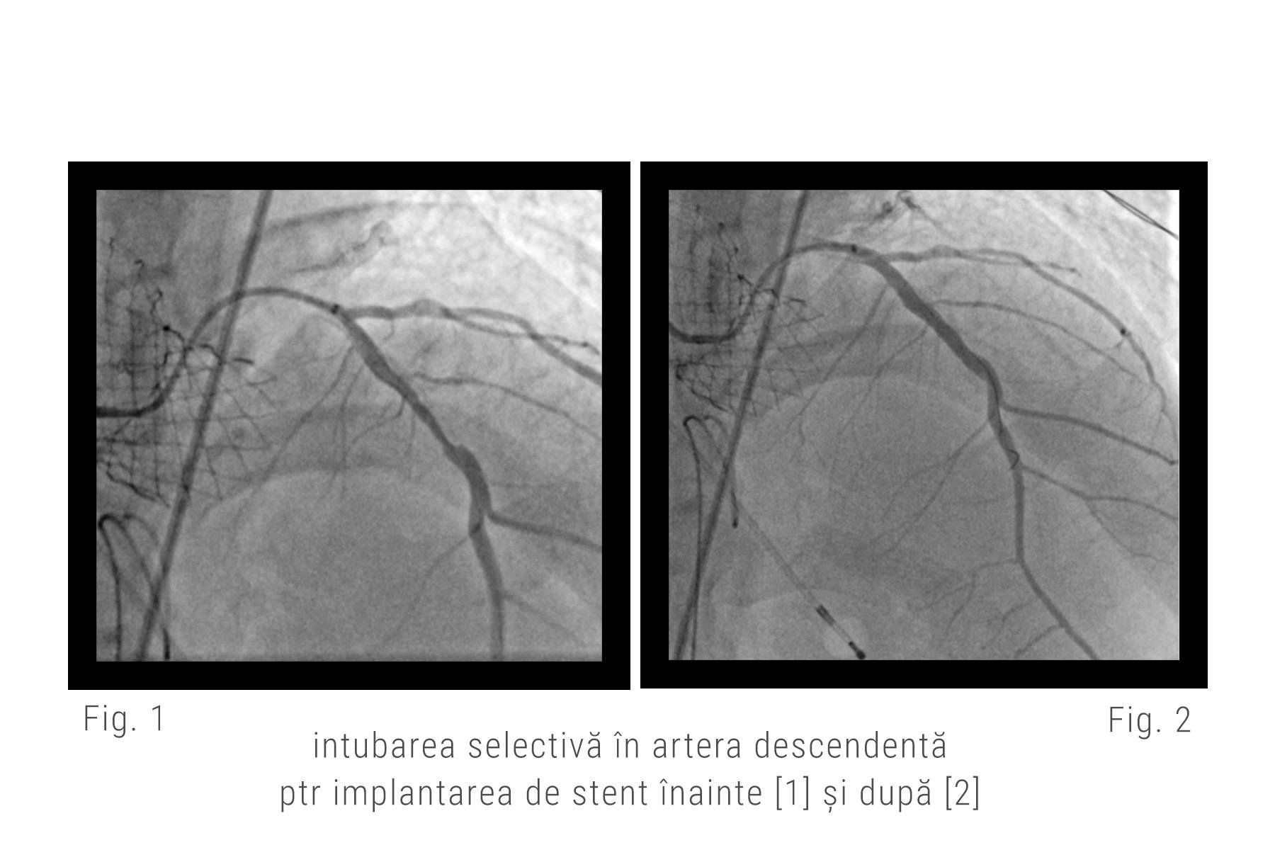 Imaginea angiografica cu intubarea selectiva in artera descendenta pentru implantarea de stenturi