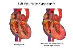 Hipertrofie ventriculară stângă: ce este, cum se manifestă și opțiuni de tratament