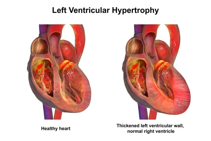 Hipertrofie ventriculară stângă: ce este, cum se manifestă și opțiuni de tratament