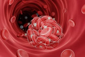 Cheaguri de sânge: Ce sunt, cauze, factori de risc și opțiuni de tratament