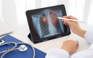 Cancerul bronhopulmonar: cauze, simptome, diagnosticare și tratament