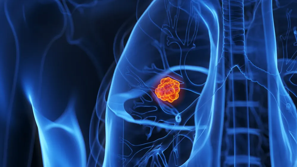 Celule de cancer bronhopulmonar văzute la microscop