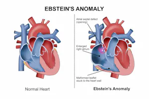 Anomalia Ebstein: simptome, diagnostic și metode de tratament