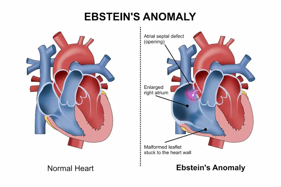 Anomalia Ebstein: simptome, diagnostic și metode de tratament