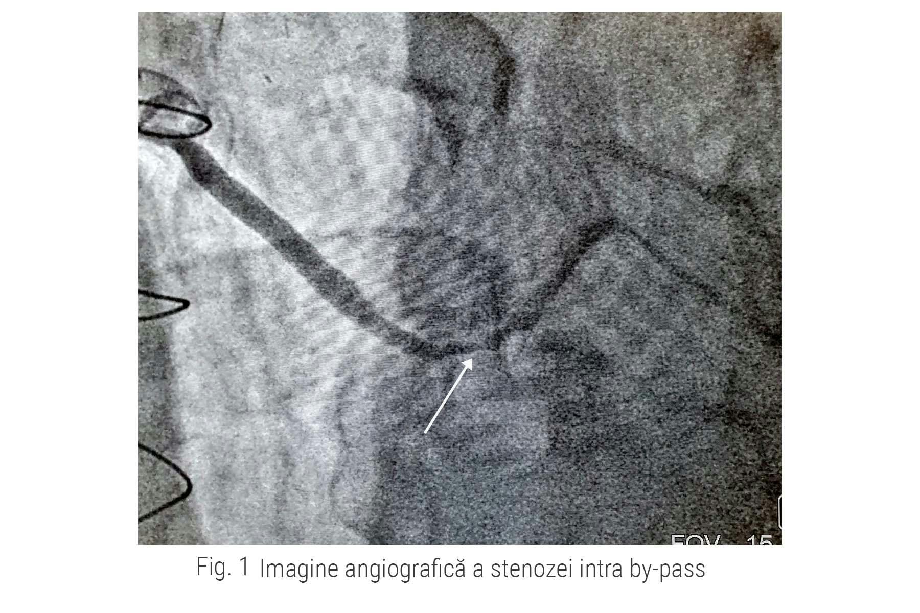 Stenoza intra bypass