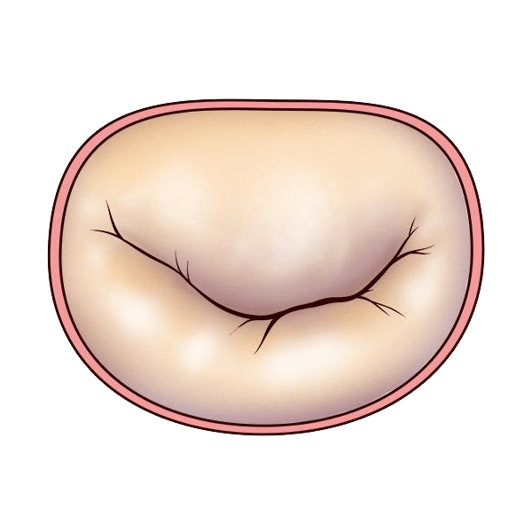 Valva Mitrala normala | Centrele ARES | Inovatie in Cardiologie