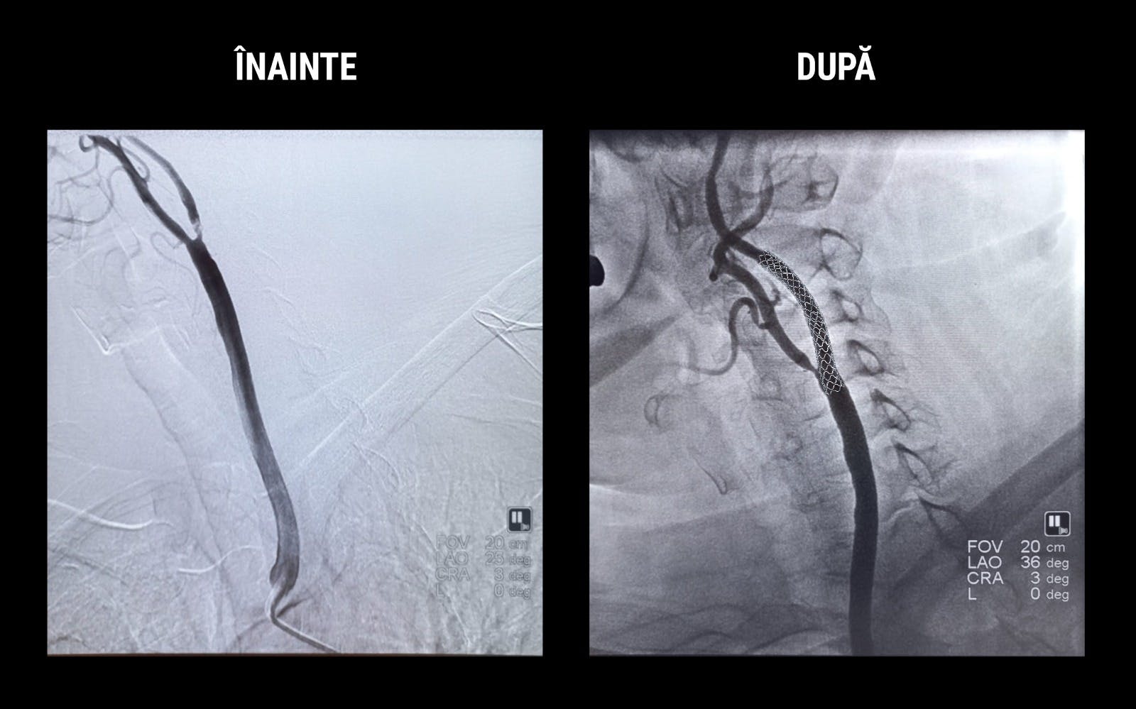 Imaginea angiografica inainte si dupa implantarea de stent carotidian