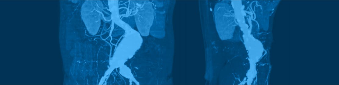 Embolizarea splenică / Tratament minim invaziv hipersplenism  | MONZA ARES