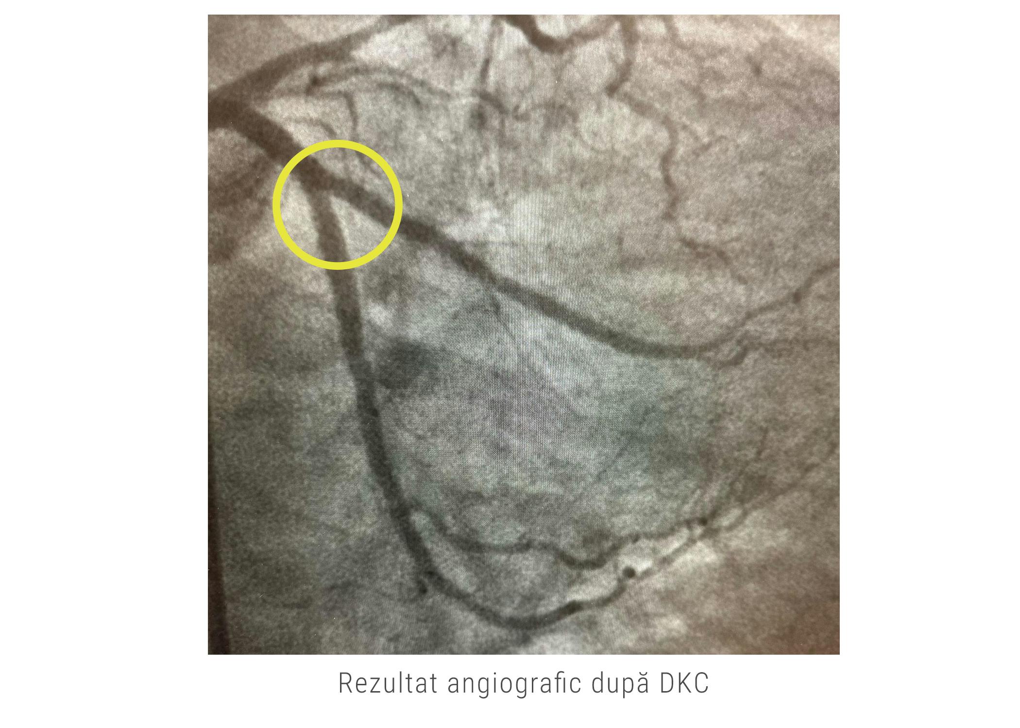 Rezultat angiorgafic după tehnica double kissing crush