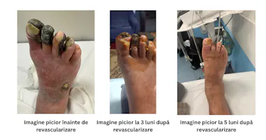 Când amputația nu este singura soluție: cum poate revascularizarea endovasculară salva un membru afectat de ischemie critică