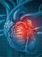 Boala coronariană cronică (stabila) - cauze, simptome, tratament