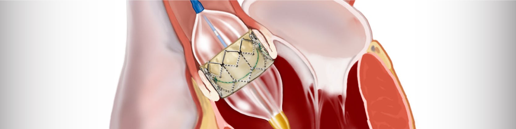 Tratament stenoza aortica – TAVI | ARES
