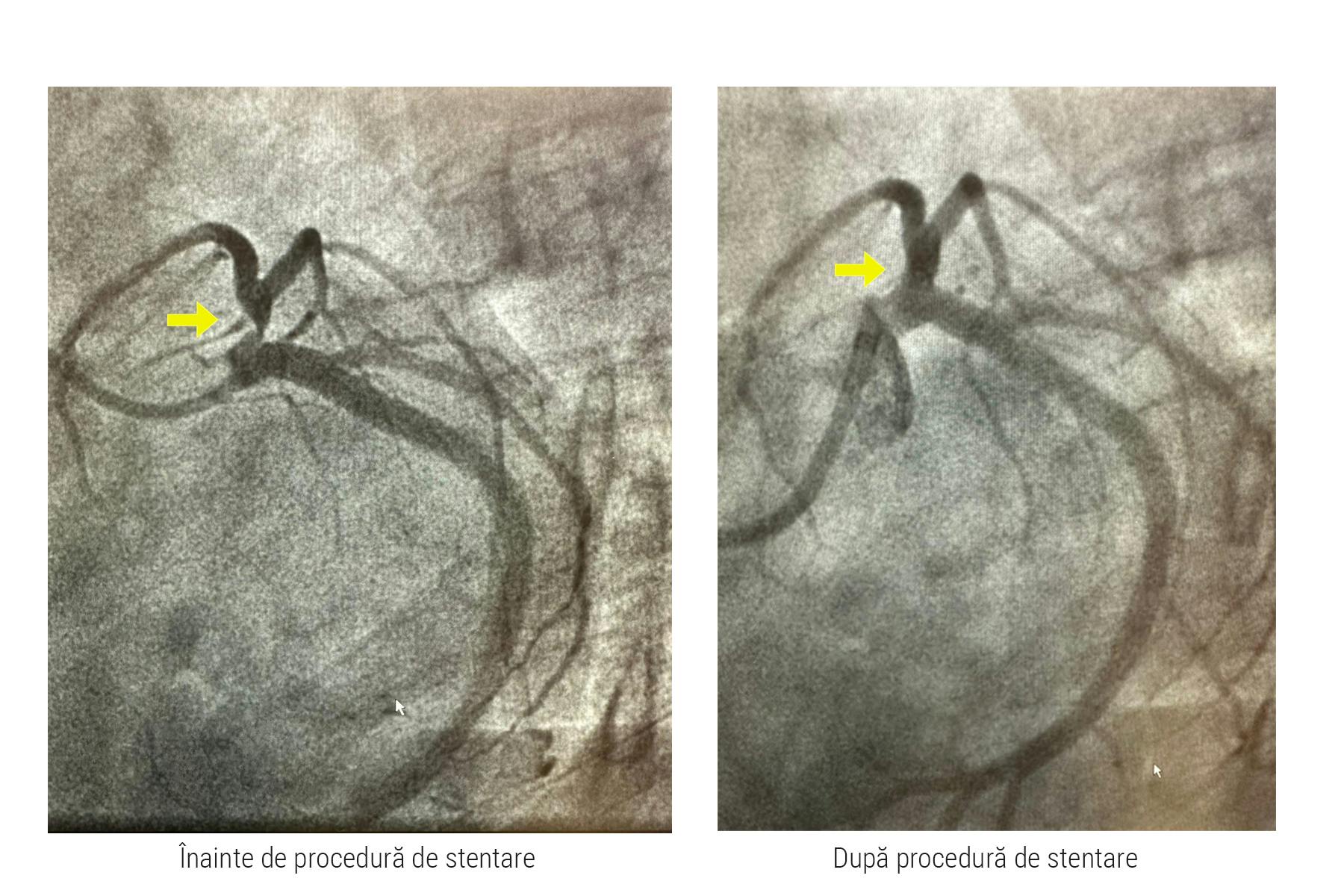 Imagini angiografice înainte și după procedura de stentare