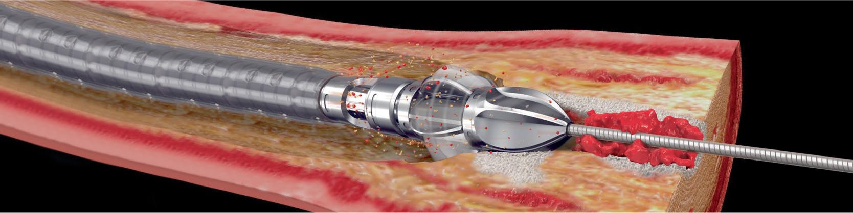 Procedura JetStream – sistem de aterectomie pentru dezobstrucția arterelor sever calcifiate | MONZA ARES