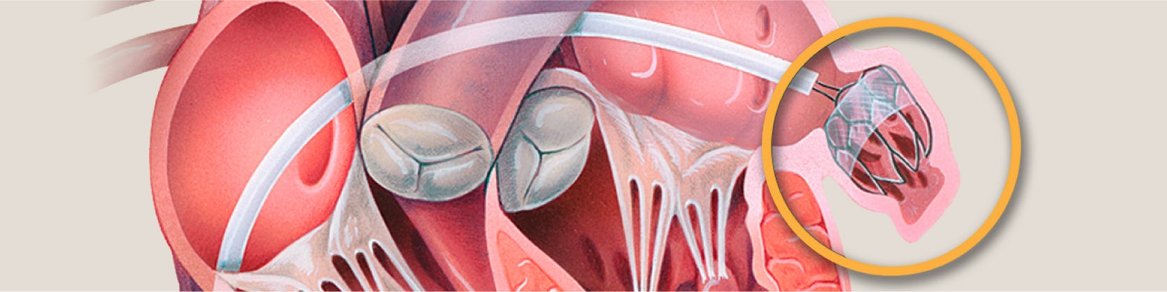 Procedura Watchman pentru Fibrilatie Atriala | MONZA ARES | Inovatie in Cardiologie