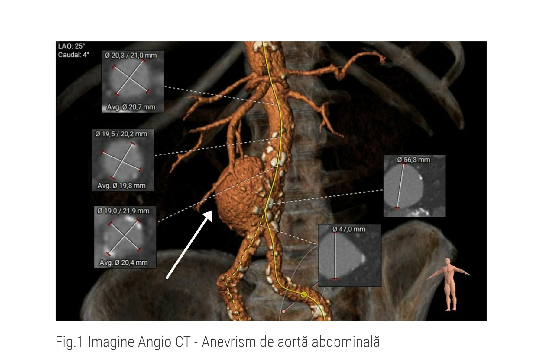 Rezultat AngioCT anevrism de aorta | Centrele Ares