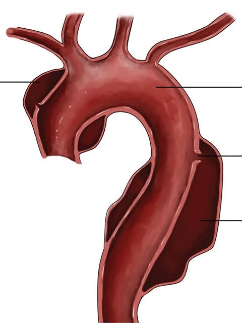 Disecția de aortă – cauze, simptome, tratament