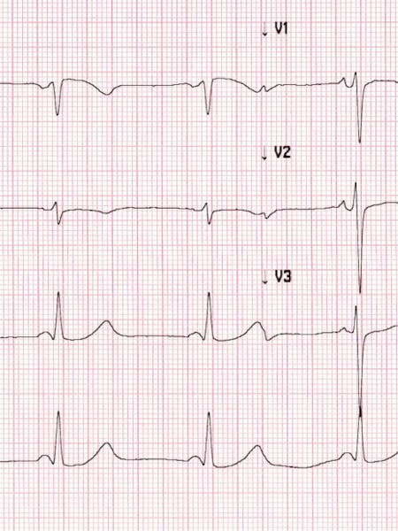 Bradicardia – cauze, simptome, tratament