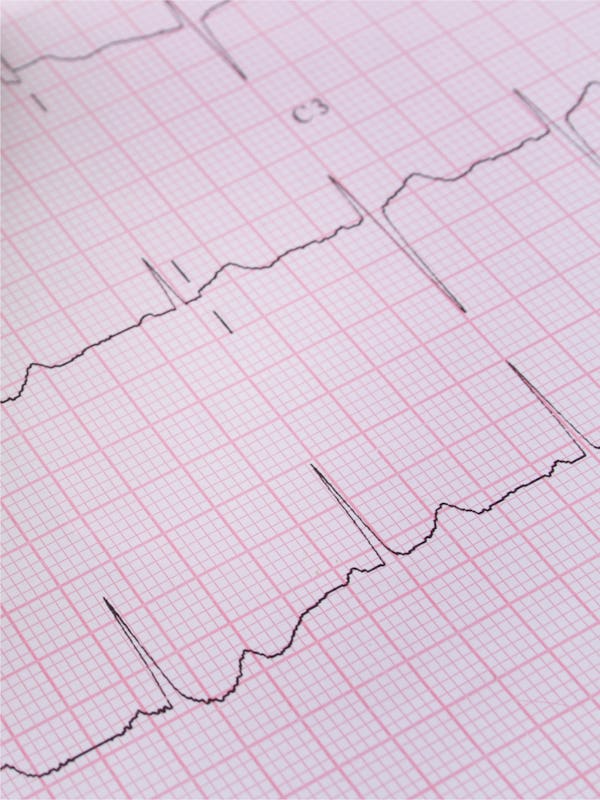 Aritmie cardiaca - cauze, simptome, tratament