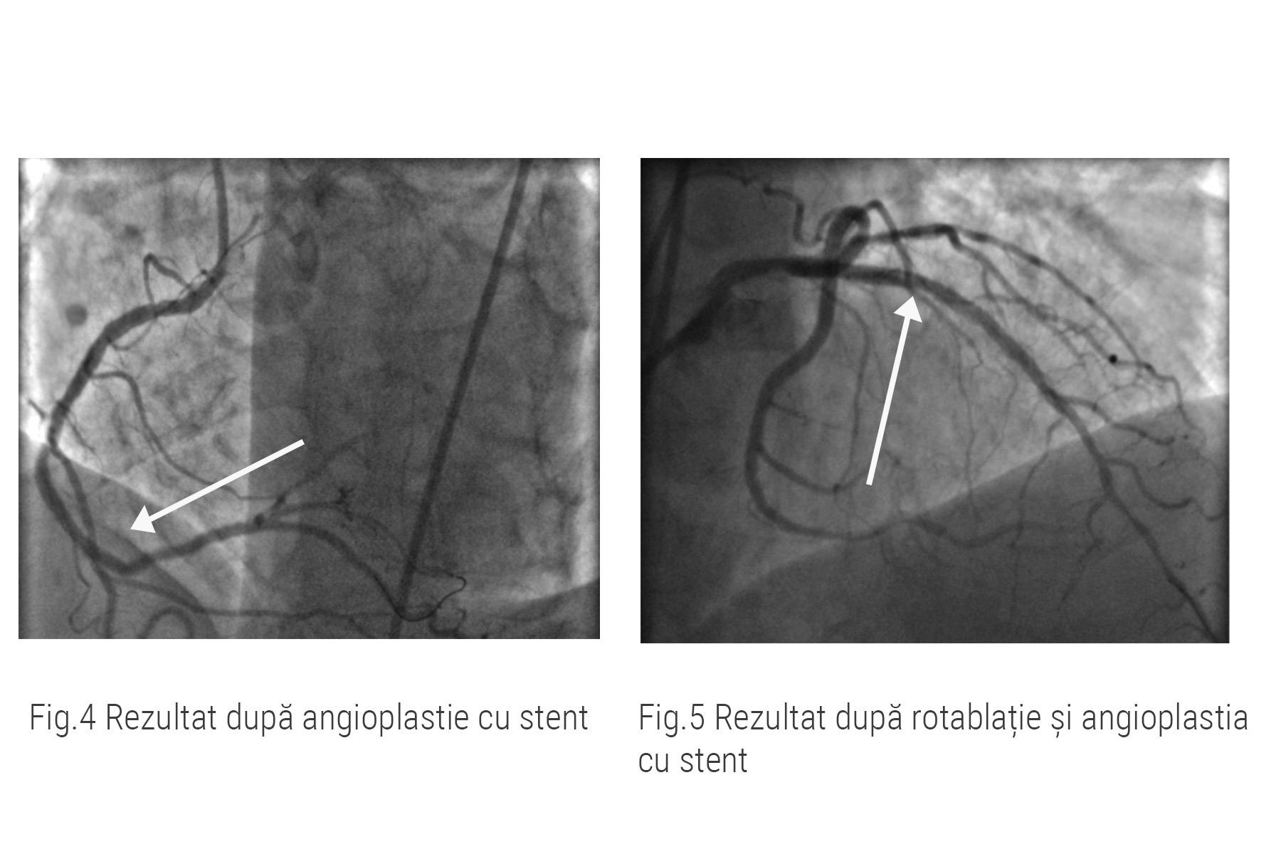 Rezultate rotablatie și implantare de stent