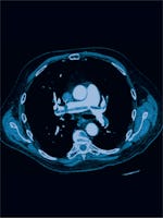 Trombembolism pulmonar - Cauze, simptome, tratament