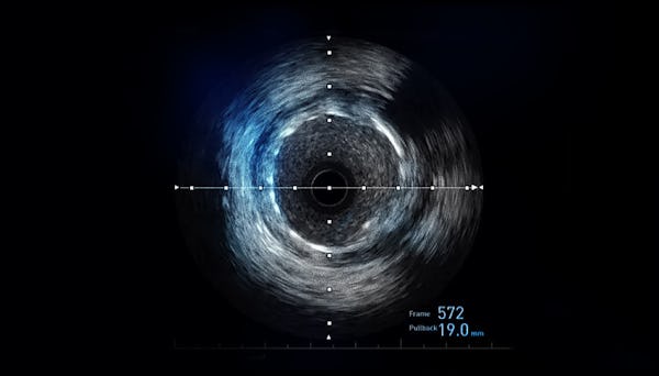 Ultrasonografia intravasculară se face la ARES - IVUS