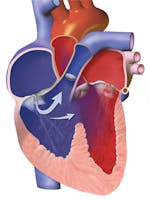 Tetralogie Fallot - cauze, simptome, tratament