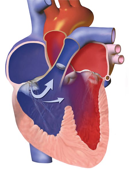 Tetralogie Fallot - cauze, simptome, tratament