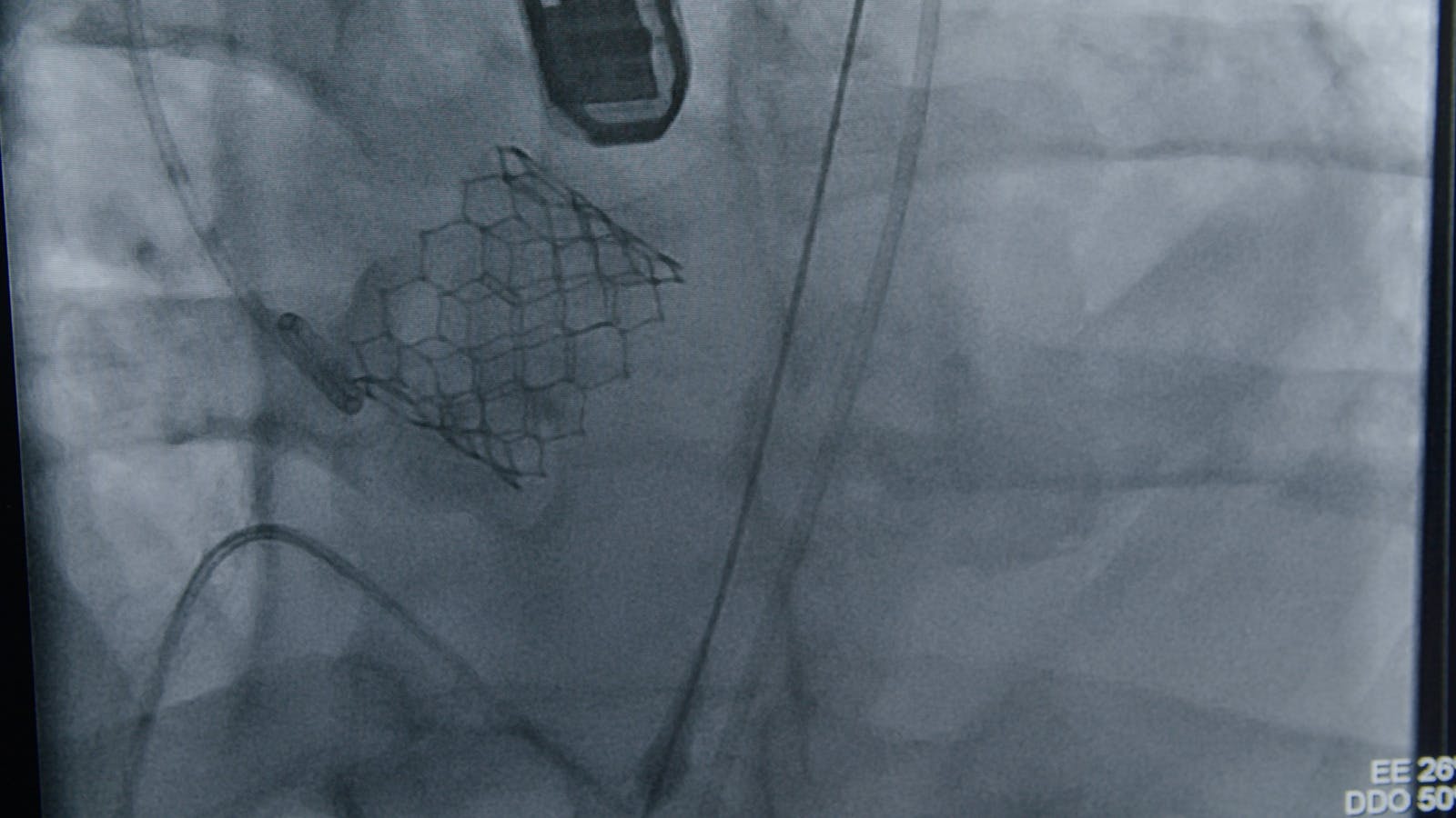 Proteza valvulară aortică implantată în interiorul inimii