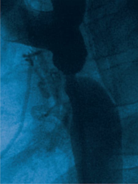 Coarctația de aortă - cauze, simptome, tratament