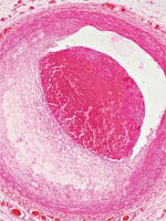 Boala cardiacă ischemică - cauze, simptome și tratament