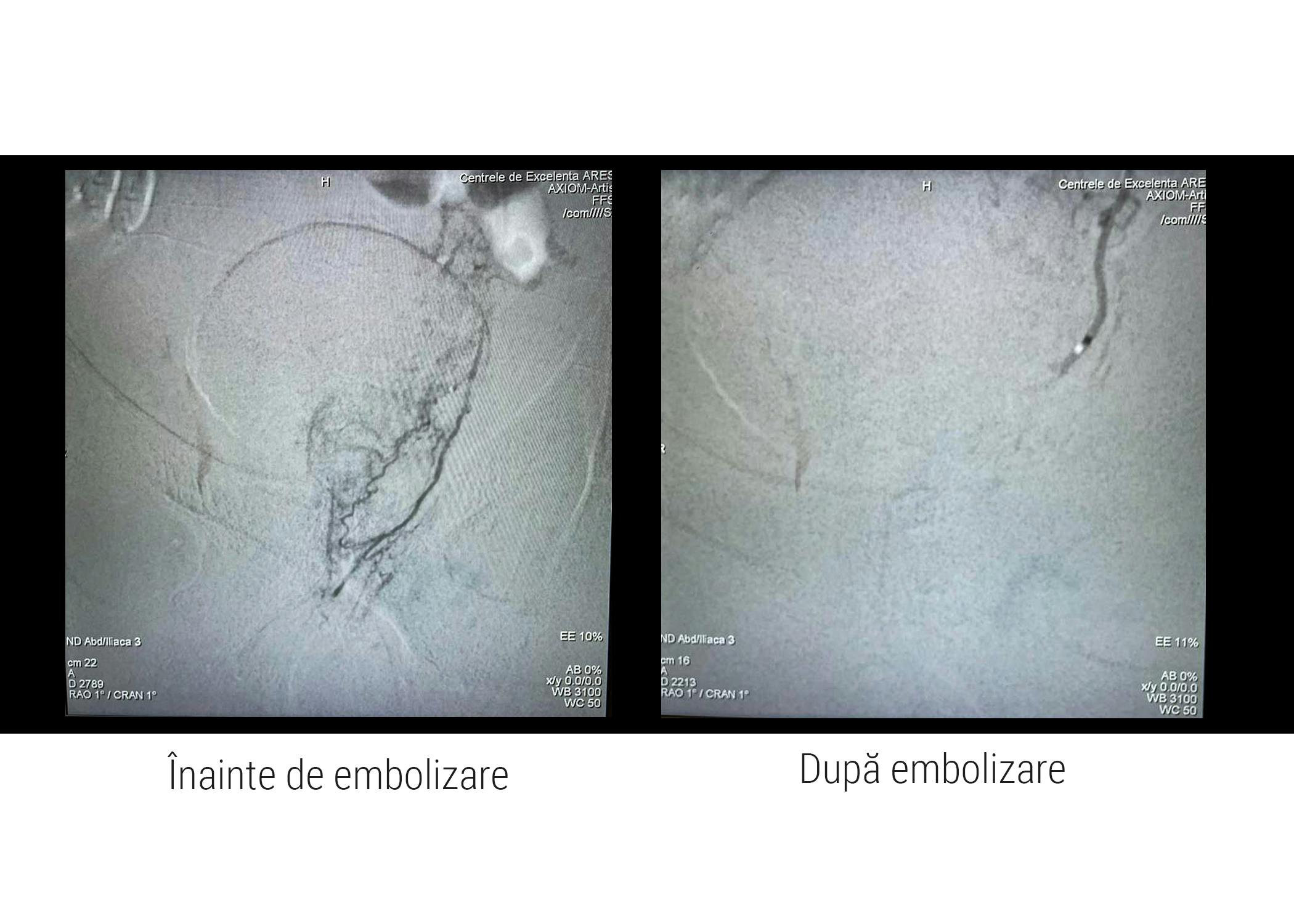Imagini angiografice înainte si dupa embolizarea adenomului de prostata