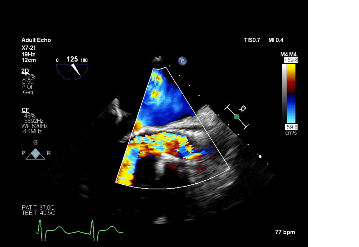 Imagine din timpul ecografiei transesofagiene preoperatorie, proteza biologică CoreValve nr 29 cu regurgitare severă intraprotetică