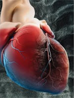 Infarct miocardic: Cauze, simptome si tratament