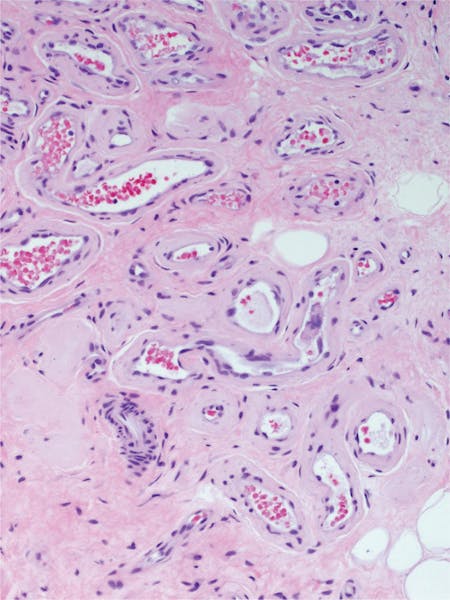 Hemangiom - cauze, simptome, tratament