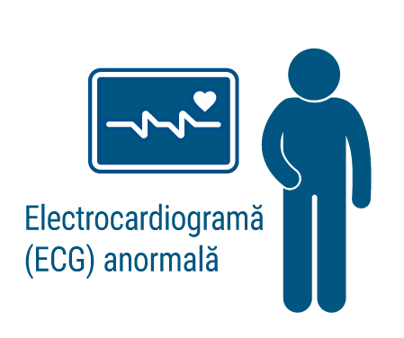 Electrocardiograma - ilustratie | Centrele ARES