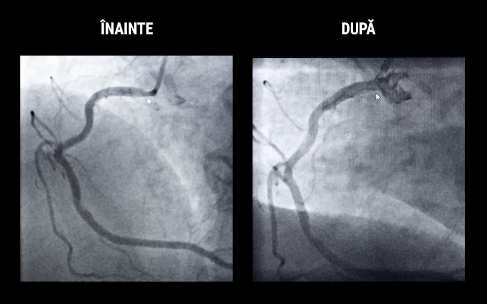 Coronarografia cu implantare de stent