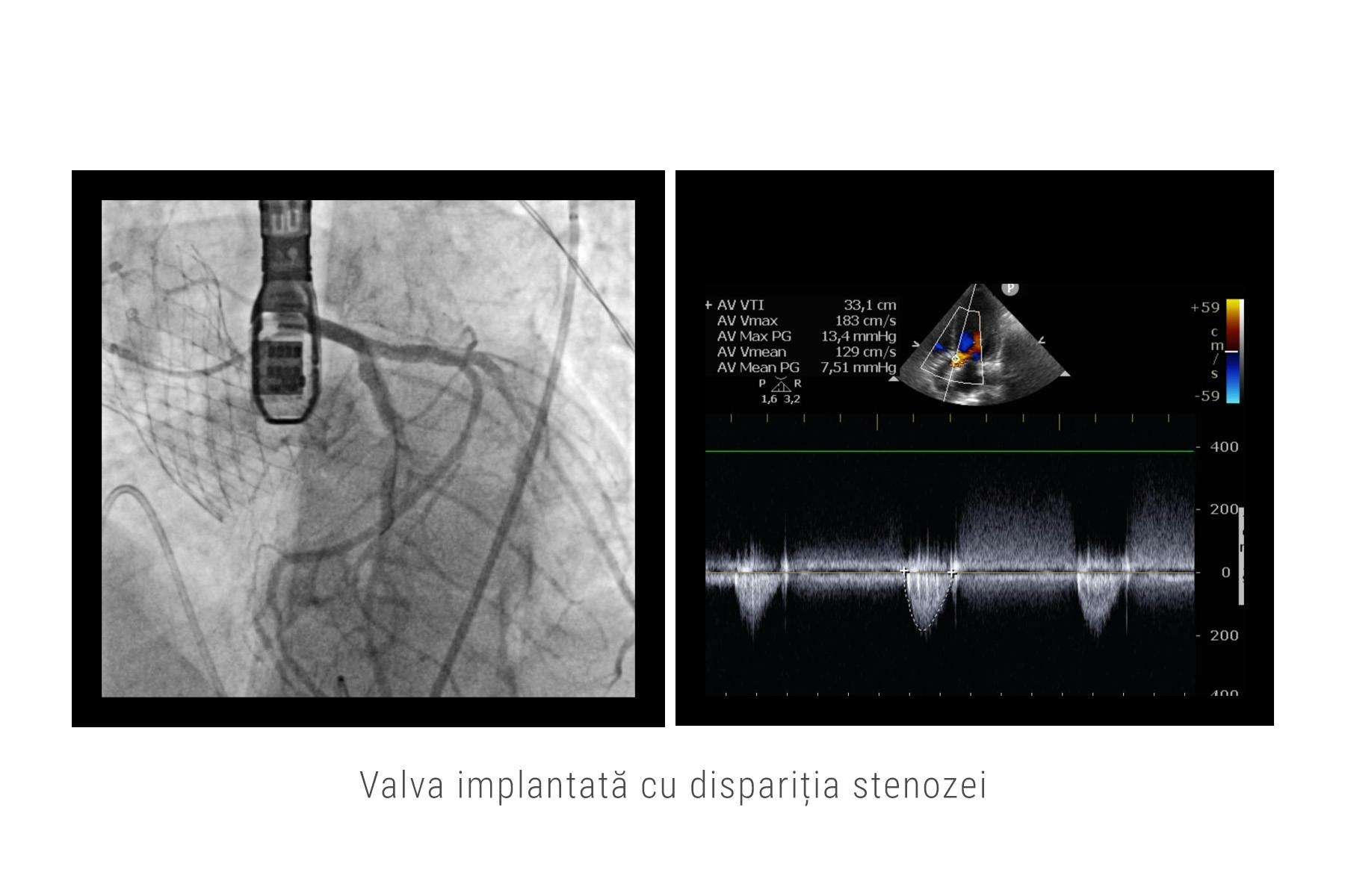 Valva implantata cu disparitia stenozei
